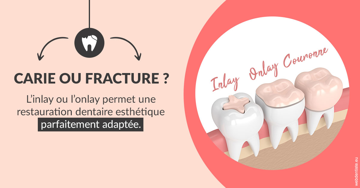 https://www.cabinet-dentaire-les-marronniers-ronchin.fr/T2 2023 - Carie ou fracture 2