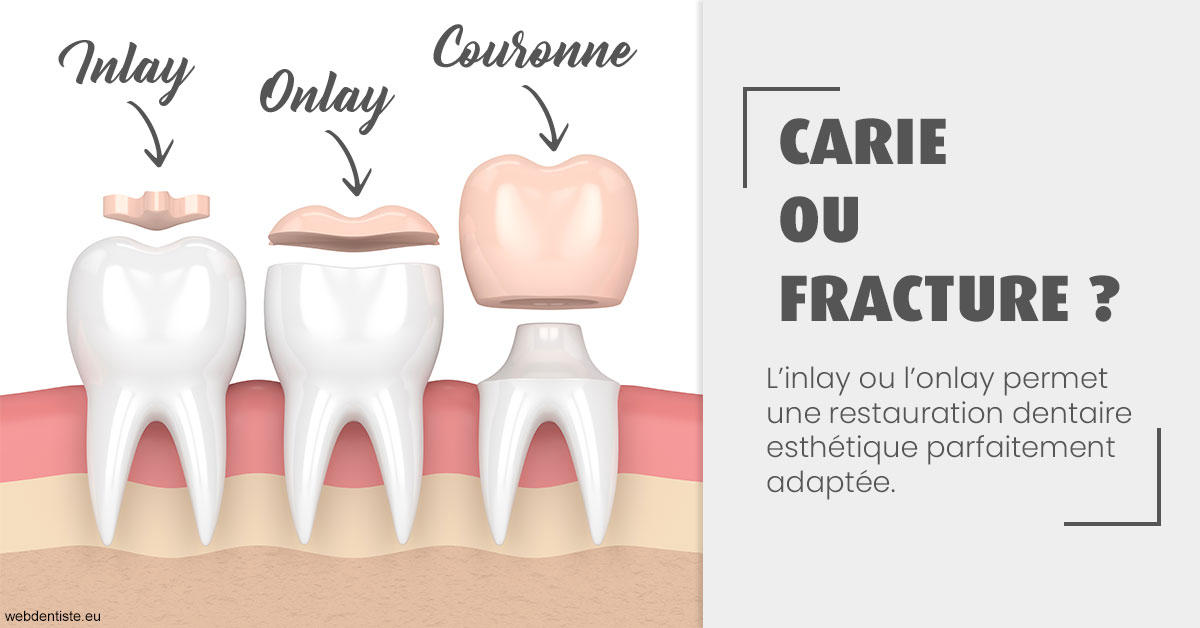 https://www.cabinet-dentaire-les-marronniers-ronchin.fr/T2 2023 - Carie ou fracture 1