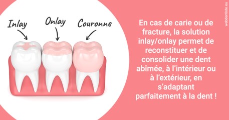 https://www.cabinet-dentaire-les-marronniers-ronchin.fr/L'INLAY ou l'ONLAY 2