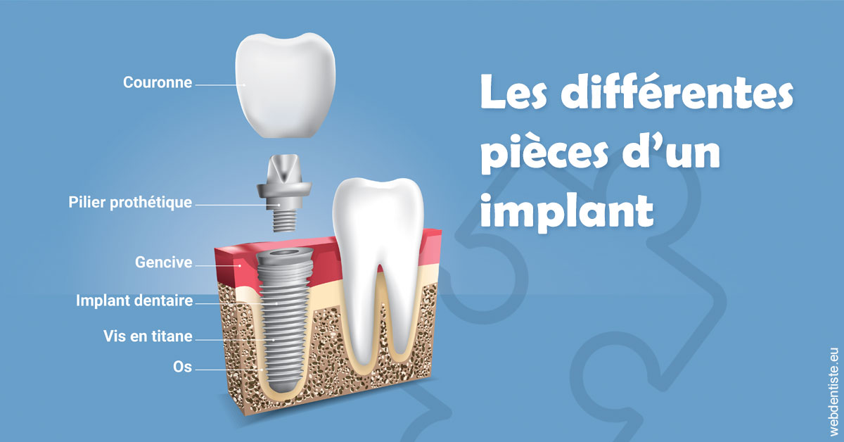 https://www.cabinet-dentaire-les-marronniers-ronchin.fr/Les différentes pièces d’un implant 1